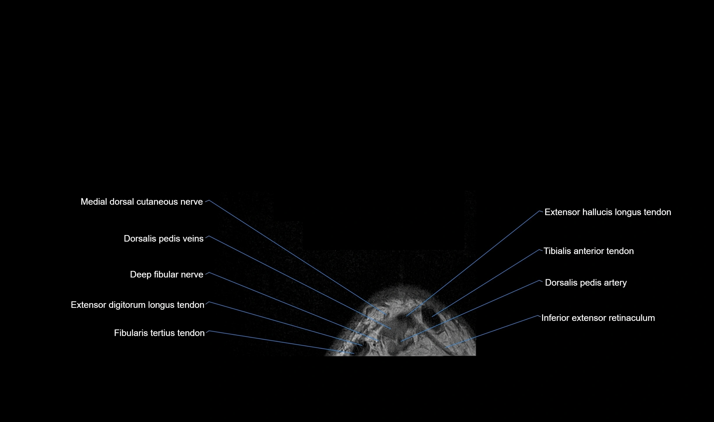 MRI mid foot coronal ligaments cross sectional anatomy 3T  radiology  image-img-00001-00002.webp
